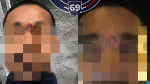 Rillieux-la-Pape : une intervention de police d&eacute;g&eacute;n&egrave;re, un fonctionnaire touch&eacute; par un mortier en plein visage