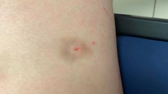 Piqûre sauvage : après le blackout d'un jeune homme, une nouvelle plainte déposée près de Lyon