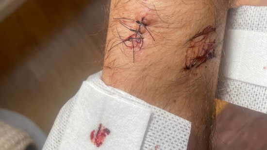 Lyon : des policiers attaqués au couteau lors d'un contrôle, Alliance dénonce des "tentatives d'homicides" Lyon : des policiers attaqués au couteau lors d'un contrôle, Alliance dénonce des "tentatives d'homicides"