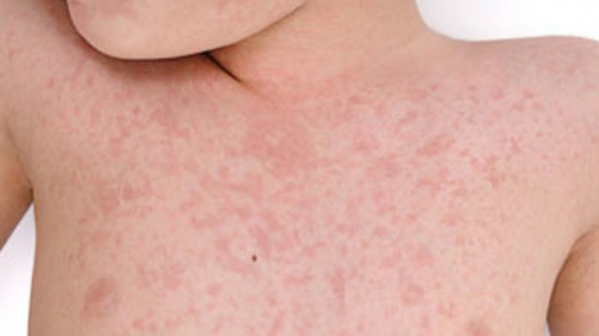 Près de Lyon : une épidémie de rougeole en cours