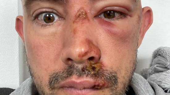 Agression de deux hommes sur les quais : "L'homophobie n'a pas sa place à Lyon !"