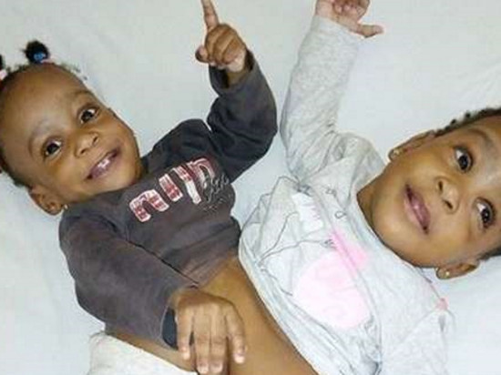 Lyon : les siamoises sont tombées malades, l'opération repoussée