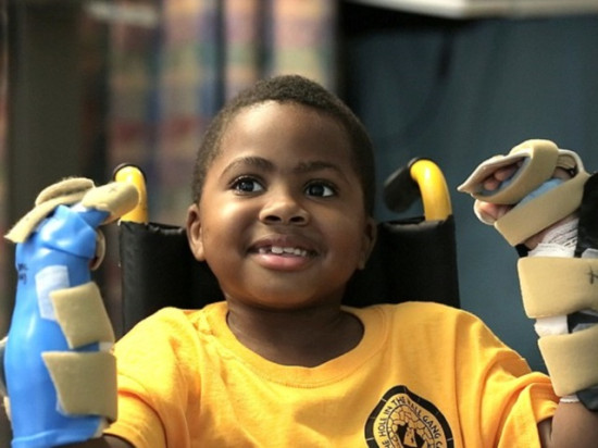 15 ans apr&egrave;s Lyon, la premi&egrave;re greffe des mains effectu&eacute;e sur un enfant aux Etats-Unis