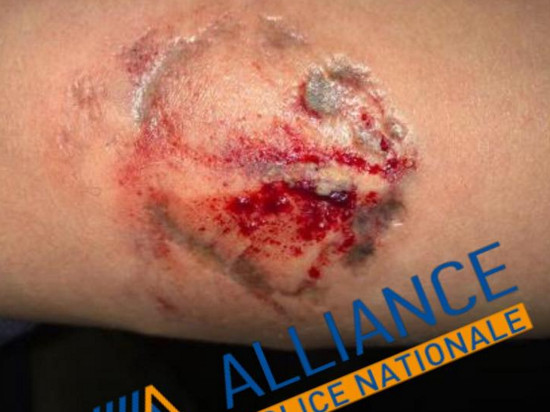 Un policier mordu au bras par un individu dans le 3e arrondissement