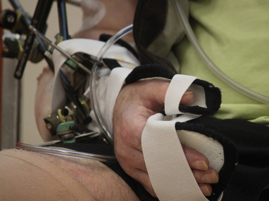 Bricolage, barbecue, Mondial : déjà 200 cas d'accidents recensés au service SOS Mains du Tonkin depuis début juillet