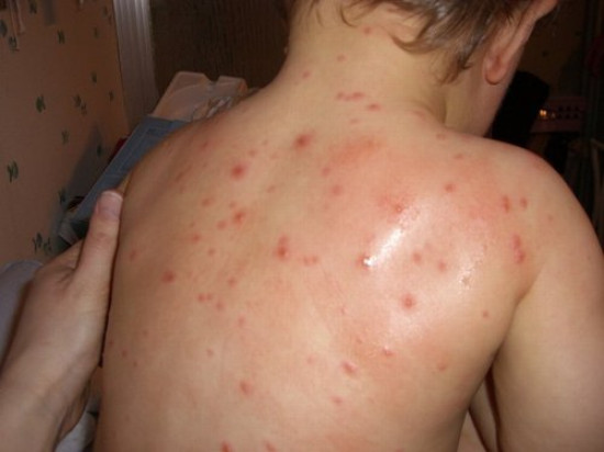 Varicelle : un pic atteint en Rh&ocirc;ne-Alpes