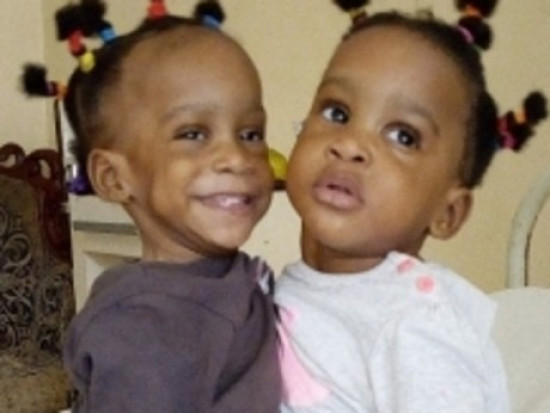 Lyon : une opération du coeur prévue pour l’une des soeurs siamoises