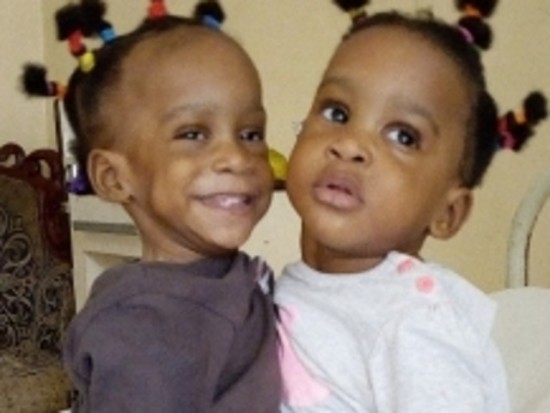 Deux petites siamoises camerounaises bientôt opérées à Lyon