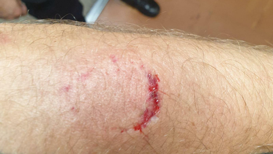 Pr&egrave;s de Lyon : il cherche &agrave; tout prix &agrave; s&rsquo;&eacute;chapper et mord le bras d&rsquo;un policier