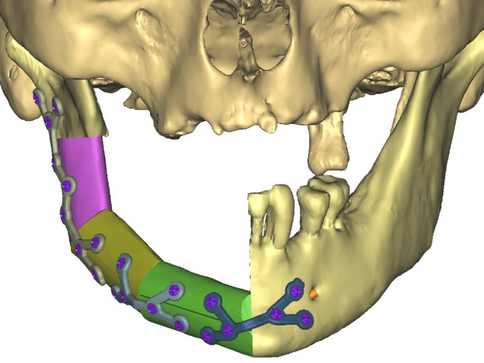 Hôpital de la Croix Rousse : quand l'impression 3D sert à la reconstitution de la mâchoire